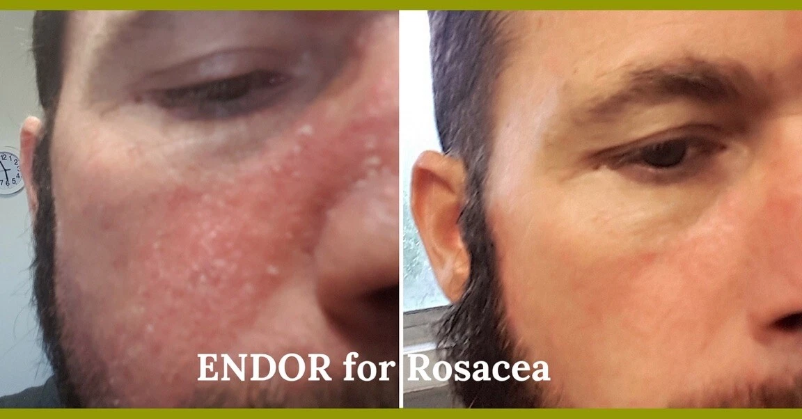 Acne rosacea 2024