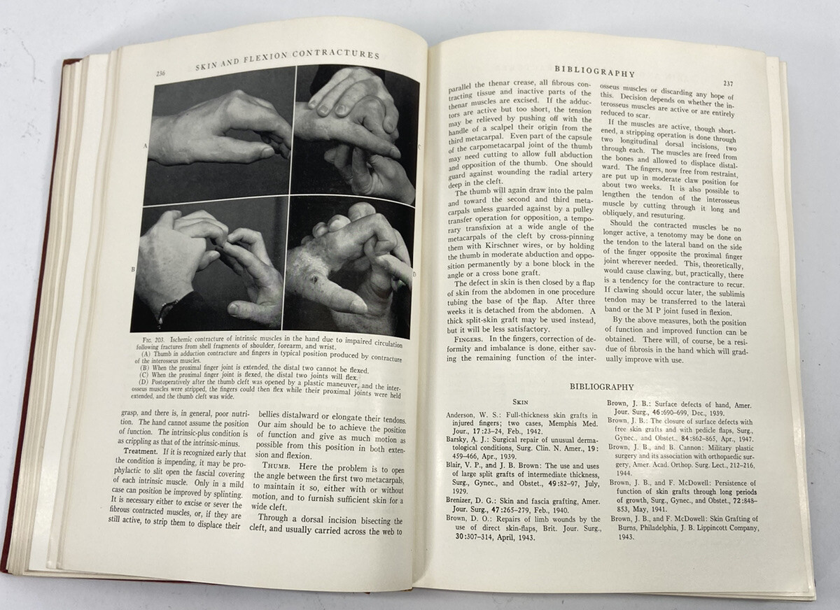 Surgery of the Hand Bunnell 2nd Edition 1948 Antique Medical Book