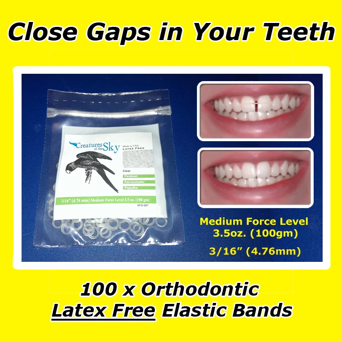 Bands To Close Teeth Gaps