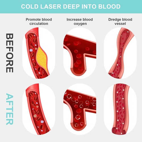 650nm & 808nm Kaltlaser Rotlicht Therapie für Nacken Muskel Schmerzlinderung - Bild 4 von 7