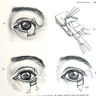 Opthalmic Plastic and Reconstructive Surgery Book Hardcover Byron C. Smith 1987