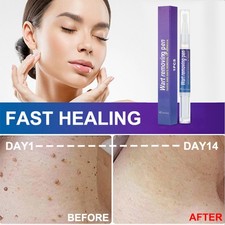 US Wart Remover Pen Eliminate Skin Tag Foot Corn Mole Warts Restoration Painless