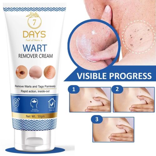 Wart Remover Cream for Men & Women, Helps to eliminate of Raise Warts 50g - Afbeelding 1 van 7