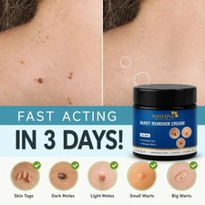 Wart Remover Cream for Men Women 50g 1.76 oz