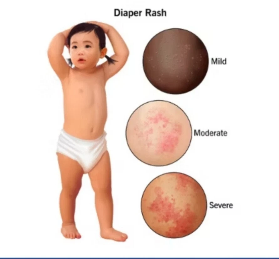 COMBIDERM CREAM FOR BABY & ADULT - Image 3 of 4