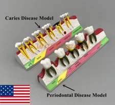 Dental Caries Periodontal Disease Dentoform Typodont Study Teaching Teeth Model