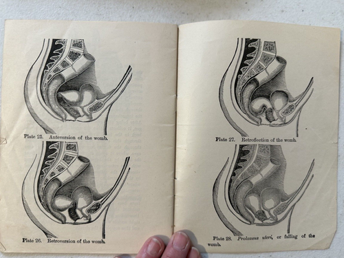 Antique medical maternity OBGYN 1894 Ideal Womanhood Motherhood abortion plates - Picture 16 of 23