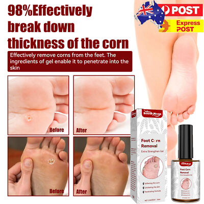 Corn and Calluses Remover Liquid Foot Callus Removal Treatment