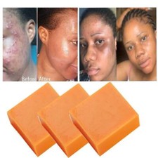 3 PACK Turmeric Soap, Dark Spots, Skin Brightening, Acne Scar Fading Natural