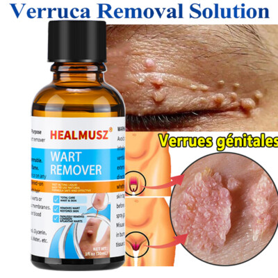 Wart Remover Liquid Skin Tag Mole Remover Eliminate Feet Corn Wart Remove Liquid