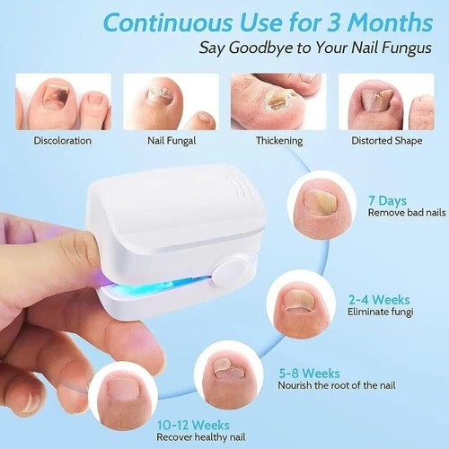 Nail Fungus Laser Device Light Therapy Antifungal Onychomycosis Toes Treatment - Picture 7 of 19