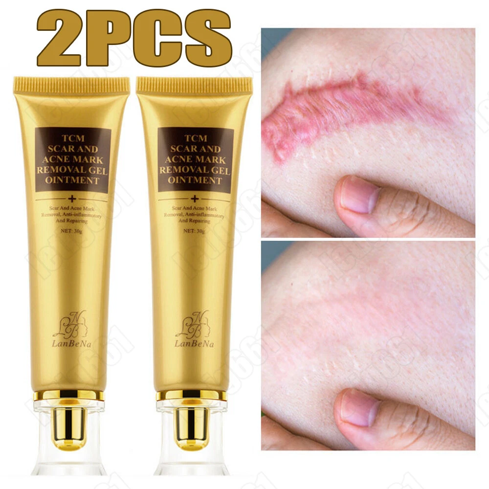 Acne marks cheap removal cream