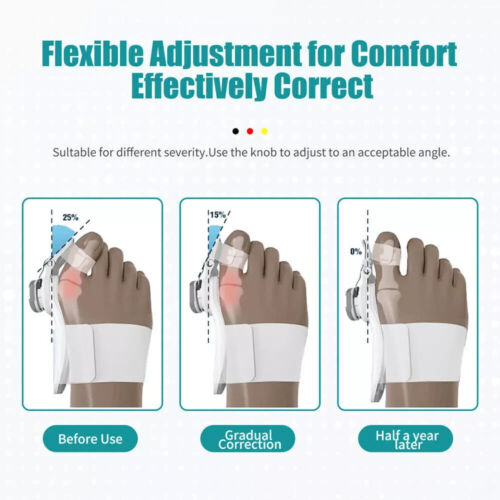 Bunion pain relief Support big toe Bunion straightener Splint corrector - Picture 3 of 4