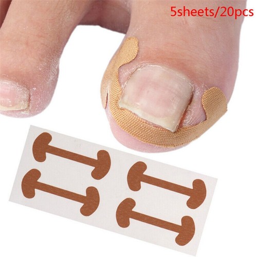 20pc set Ingrown Toenail Corrector Stickers Paronychia Treatment Toe Nail Care - Bild 2 von 11