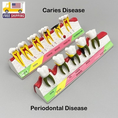 Dental Pathological Typodont Teeth Model Periodontics Endo Disease Assort Demo