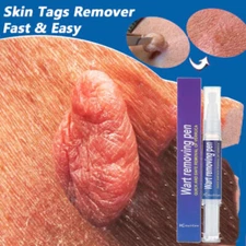 Skin Tag & Wart Remover Pen Painless Removes Common Plantar Warts Foot Corns 5ML