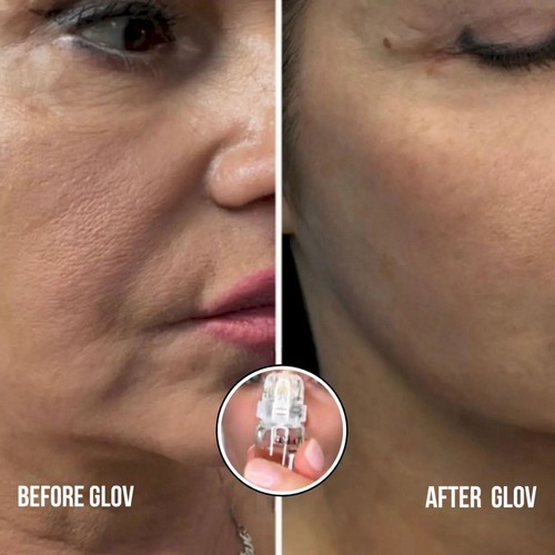 Glamory Mikro-Infusionssystem für Gesicht Lippen hält Feuchtigkeit und erfrischt - Bild 13 von 23