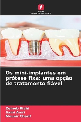 Os mini-implantes em prtese fixa: uma op??o de tratamento fi?vel von Zeineb Riahi