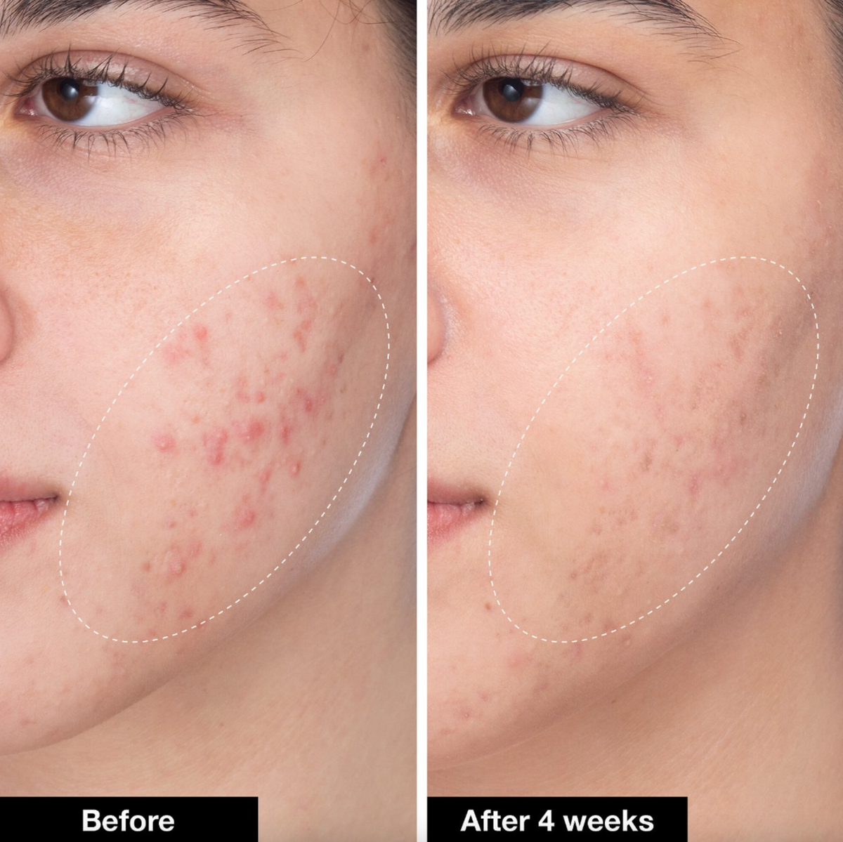 美容液 r.deal acne treatment serum 30ml Bubble Skincare Super Clear Acne Treating Serum, 30 mL