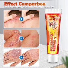 60g Dermatitis Creme Natürliche Ganzkörpercreme Hautpflege Dermatitis Ekzeme