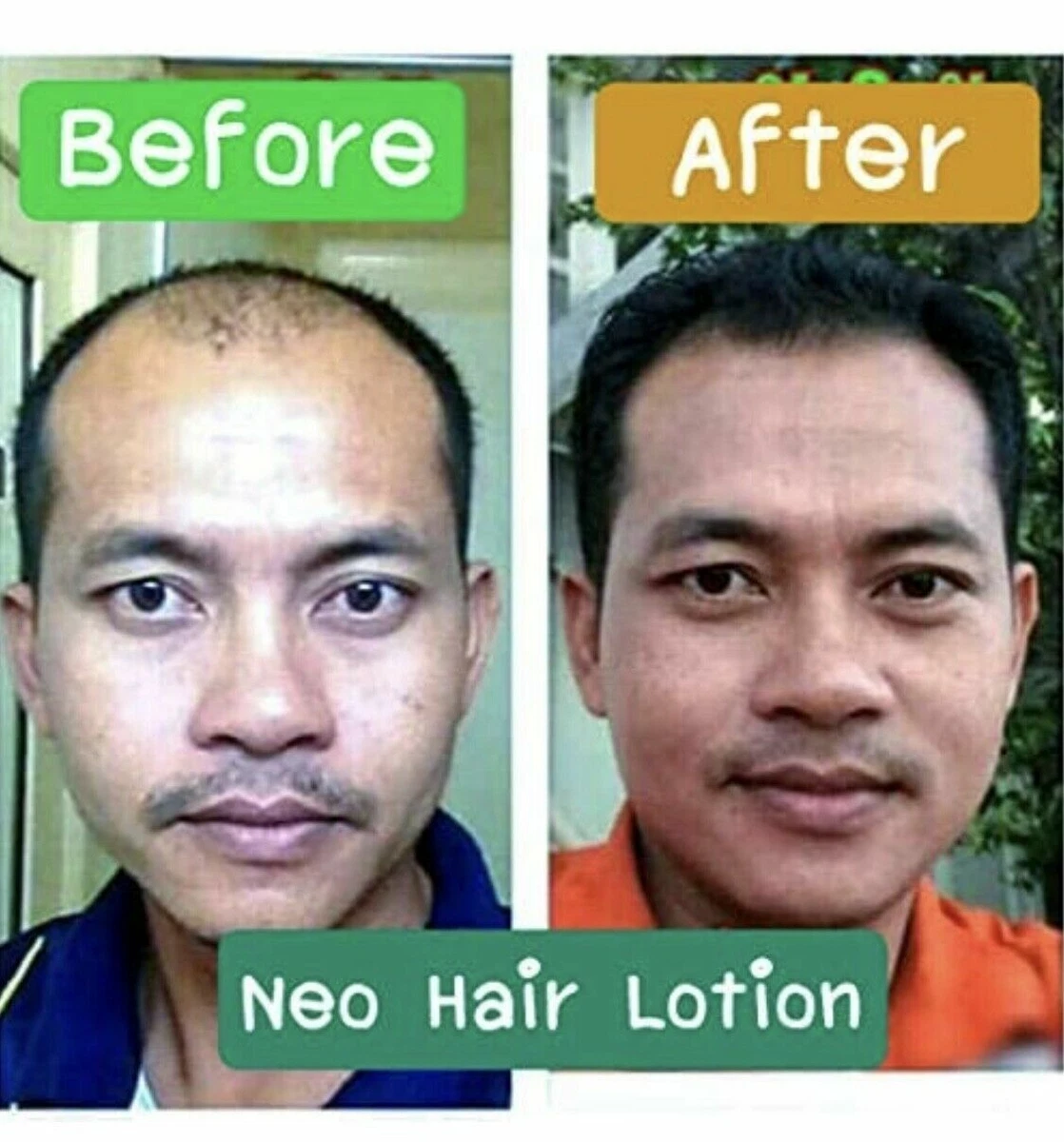 Discover more than 138 neo hair lotion side effects latest tnbvietnam