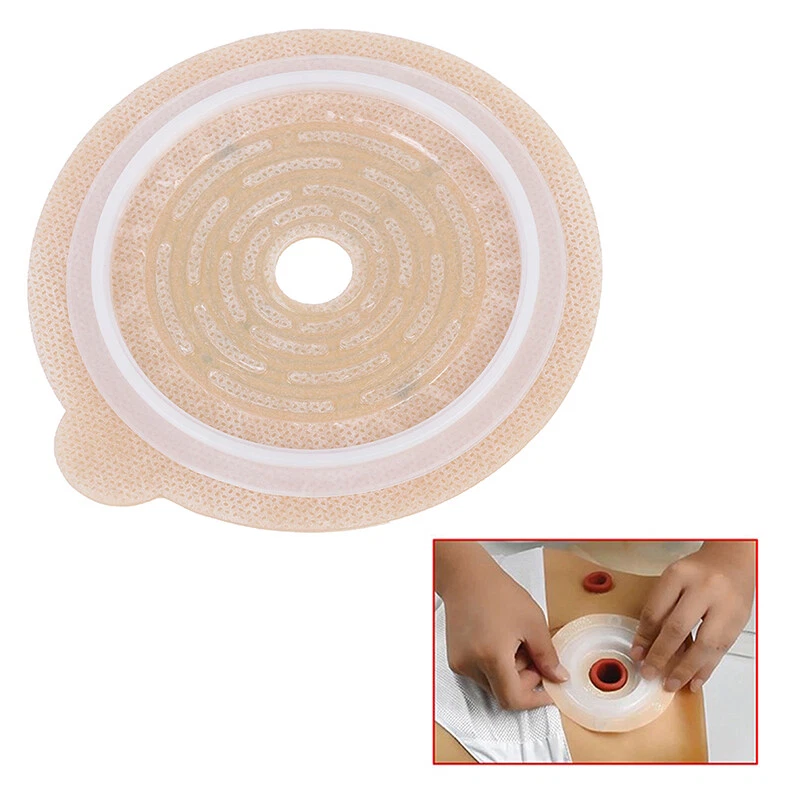 Top more than 141 parts of an ostomy bag kidsdream.edu.vn