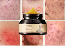 EFICAZ Crema para el acn ELIMINA Espinillas Espinillas Manchas hombres y mujere
