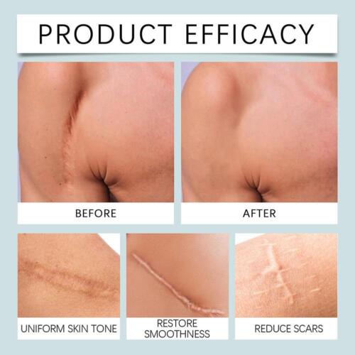 Silicone Scar Sheet Scar Removal,Silicone Tape Waterproof Patch -Scar M4Q1 - Picture 15 of 20