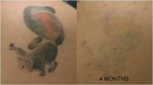 Permanente Tattooentfernung Creme MADE IN USA T - Bild 3 von 6