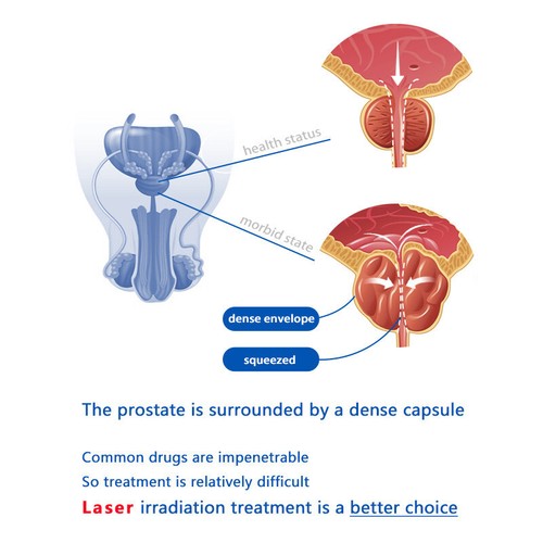 Prostate Laser Therapy Device for Dysuria Nocturia Frequently Prostatitis forMen - 第 11/14 張圖片