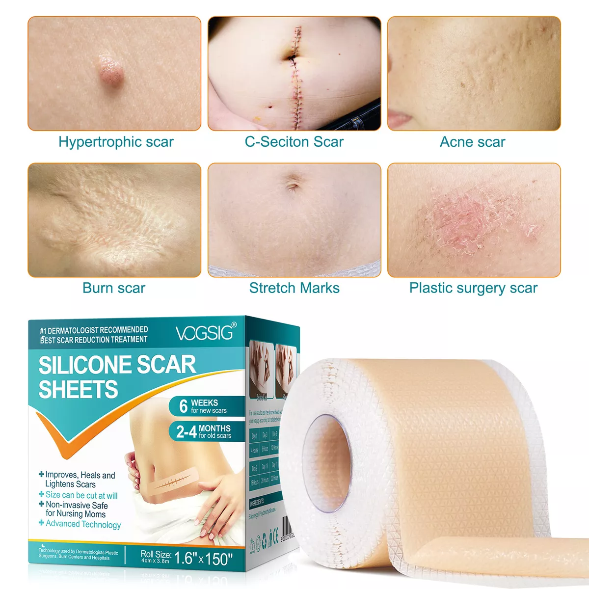 Scar Removal Silicone Tape for Hypertrophic Scars & Keloids, 1.6'' x  60''-150