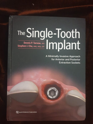 Single-Tooth Implant : A Minimally Invasive Approach for Anterior and Posterior