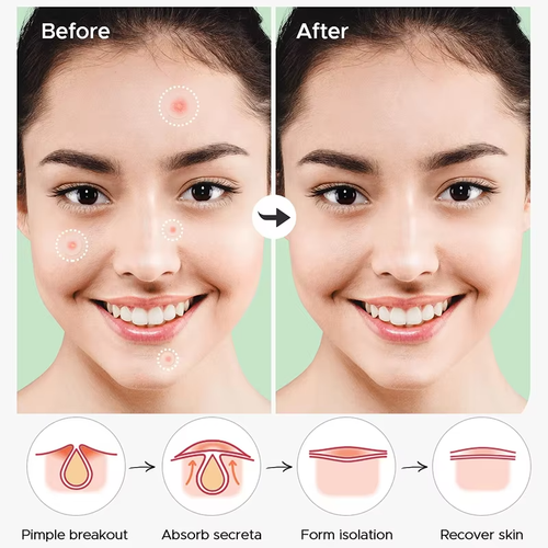 20 packs of 36 patches - Acne, spot, pimple, salicylic acid, tea tree leaf oil. - Picture 8 of 10