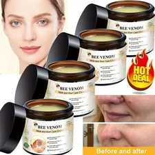 Bee Venom Skin Tag Removal Treatment Cream Body Care Mole Corn Wart Remover-2025