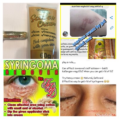 Lot 2 Syringoma Cream Remove Syringoma Scarless Cream Fade and Lighten ...