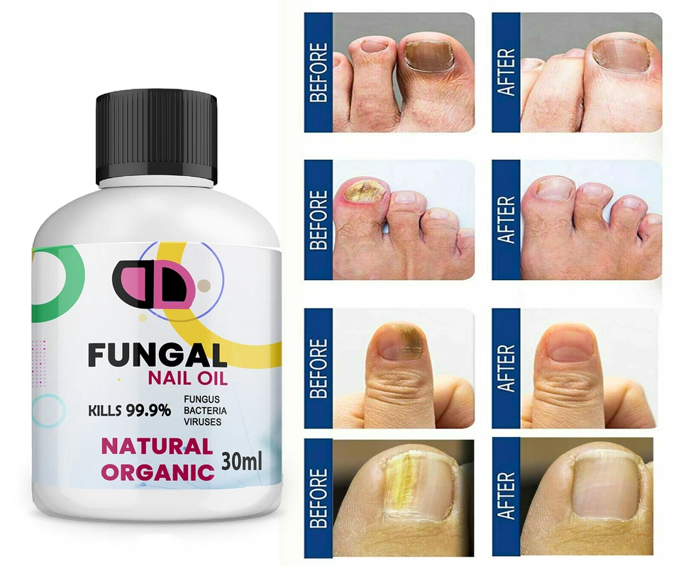 30ML Fungal Nail Treatment Highly Effective Kill Nail Fungus For Best Result UK