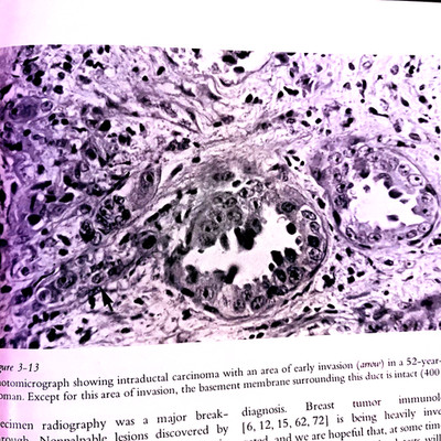 Vintage Plastic and Reconstructive Surgery of The Breast Book Hardcover 1976