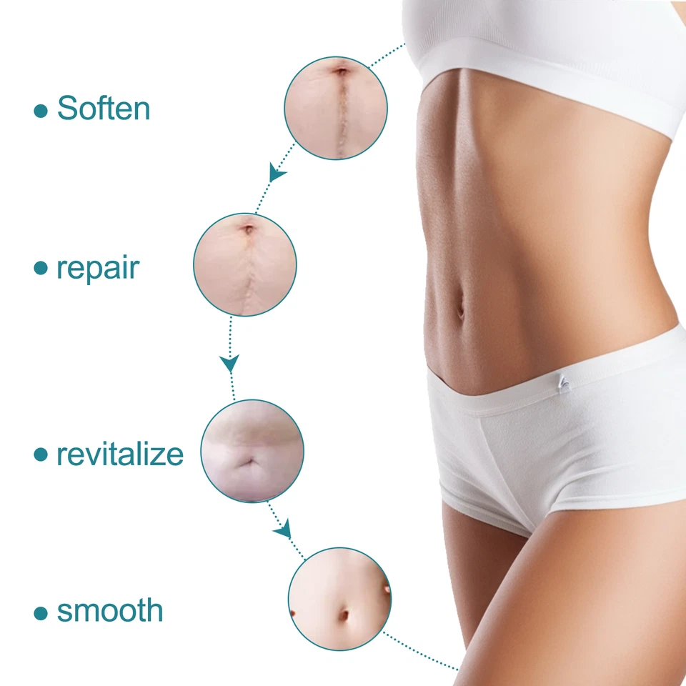 Scar Removal Silicone Tape for Hypertrophic Scars & Keloids, 1.6'' x 60''-150" - Image 4 of 4