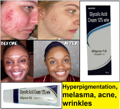 GLYCO 12 Glycolic Acid CREAM 12% - Reduces Wrinkles, Prevents Acne 30 gm