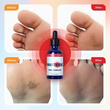 Fast Acting Burn Warts To Remove Warts Remedy Wart Callus Remover