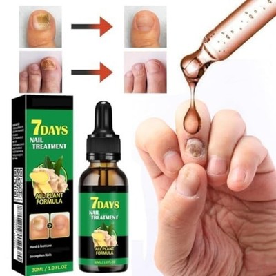 2Pcs 30ML Ginger 7-Day Toenail Fungus Repair for Discolored Thick Damaged Nails