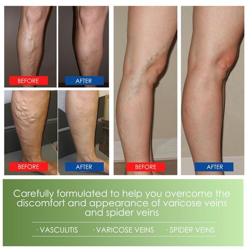 3X Instant Relief,Var icose Vein cream,Deep nourishing,improving varicose veins - Picture 5 of 10