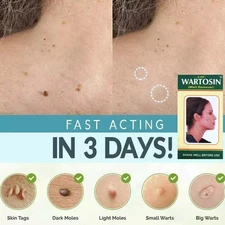 NEW SKIN TAG REMOVER CREAM SAFE FAST WART REMOVAL MOLE ACNE PIMPLE PATCH SPOT UK