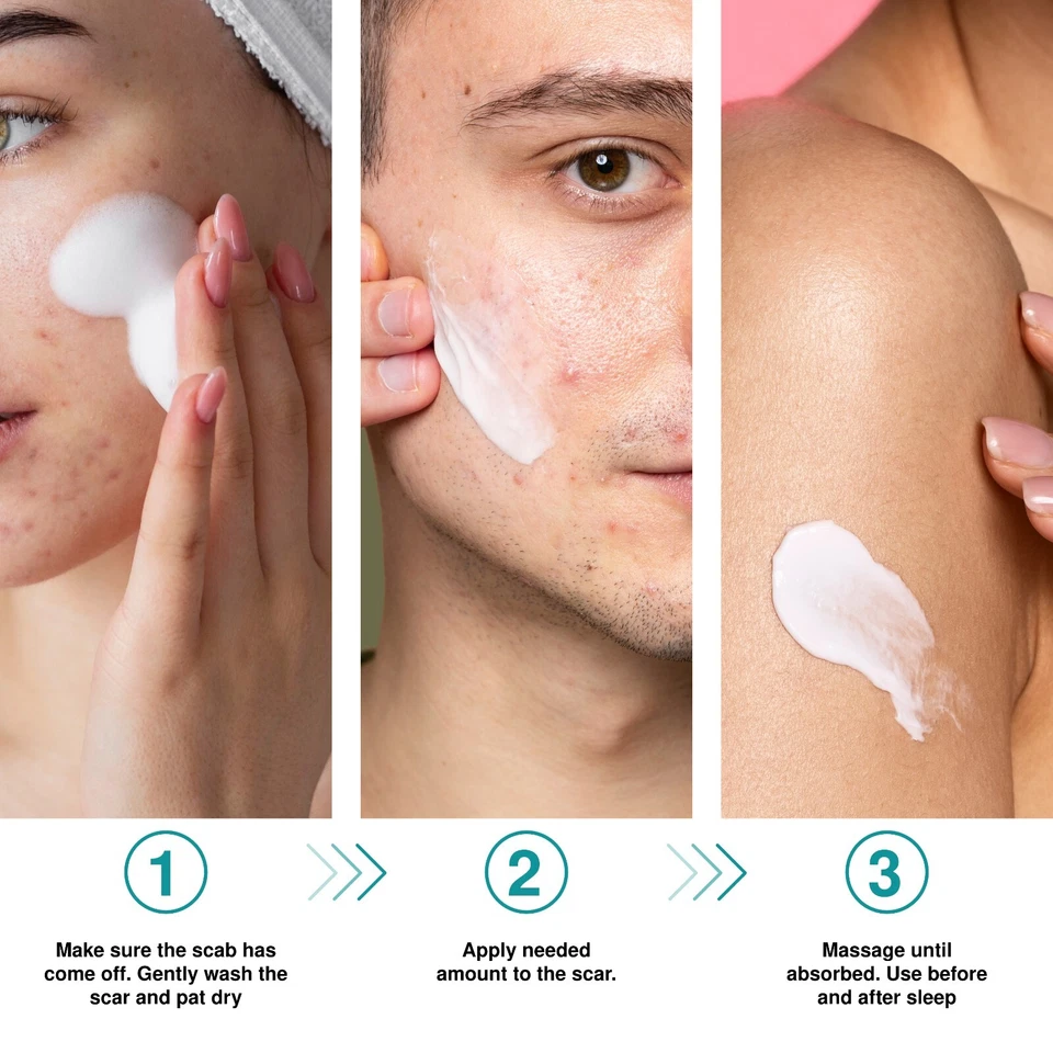 Scar Removal Advanced Cream Treatment Gel for Surgical Scars, Acne Scars, C-Sect - Image 2 of 4