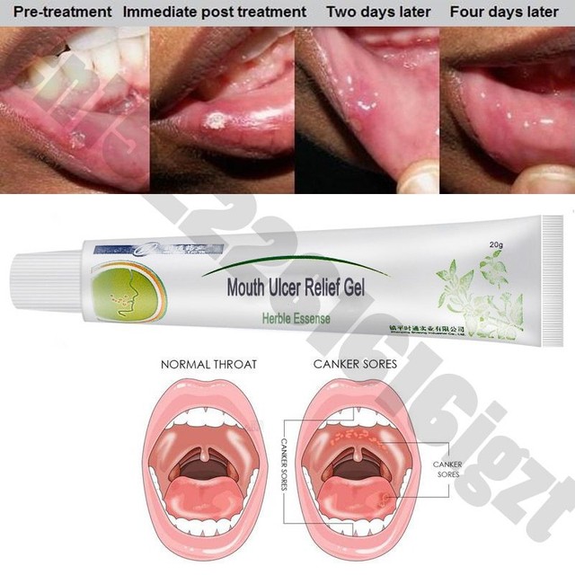 Mouth Sores Treatment Ulcers Gel Canker Fast Relief Natural Oral Antibacterial - 