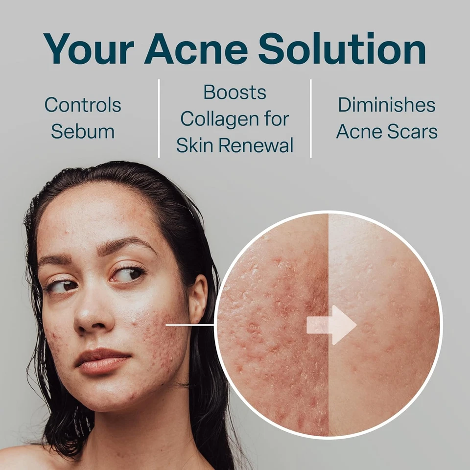 Almohadillas de control de acné QRxLabs ácido glicólico + salicílico con 10% ultra puro... Foto 4 de 4