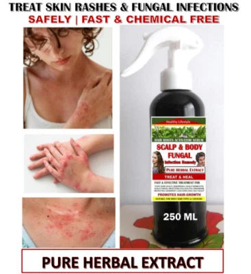 TREAT & HEAL Fungal Infection Scalp & Body Botanical Best Remedy - PURE HERBAL EXTRACT 250 ML