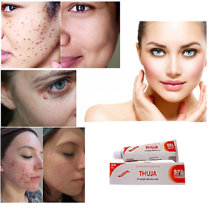 thuja ointment for pimples