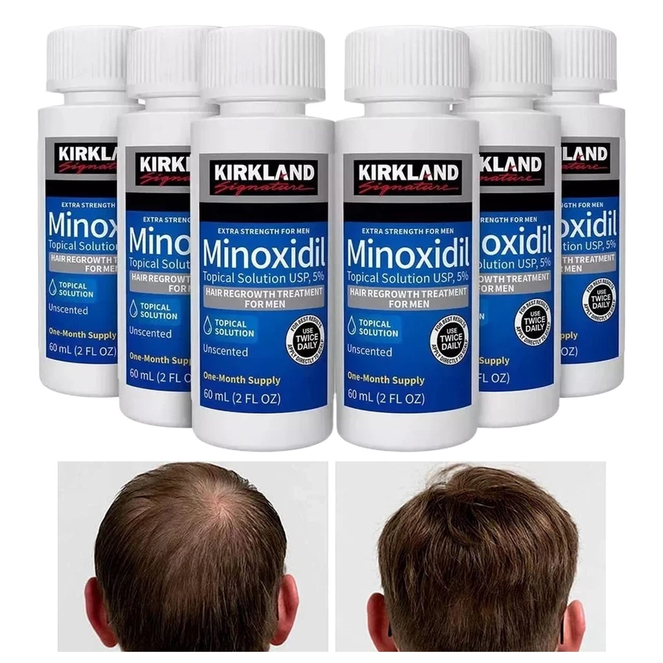 6er-Pack Minoxidil 5 % extra starke Haarwuchsbehandlung für Männer, 6-Monats-V - Bild 2 von 4