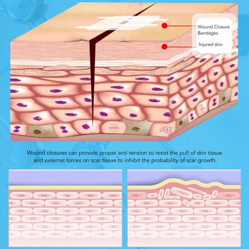 10x Emergency Wound Closures Adhesive Seamless Cuttable Hygienic Zip Stitch - Picture 7 of 23